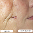 Natural Botulinum 8-Week Microinfusion System™