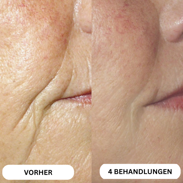 Natural Botulinum 8-Week Microinfusion System™
