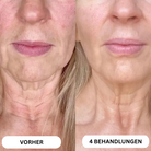 Natural Botulinum 8-Week Microinfusion System™