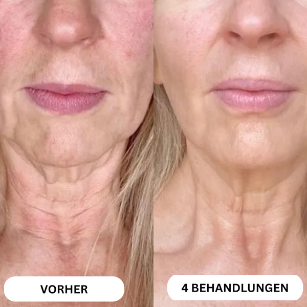Natural Botulinum 8-Week Microinfusion System™