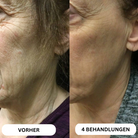 Natural Botulinum 8-Week Microinfusion System™